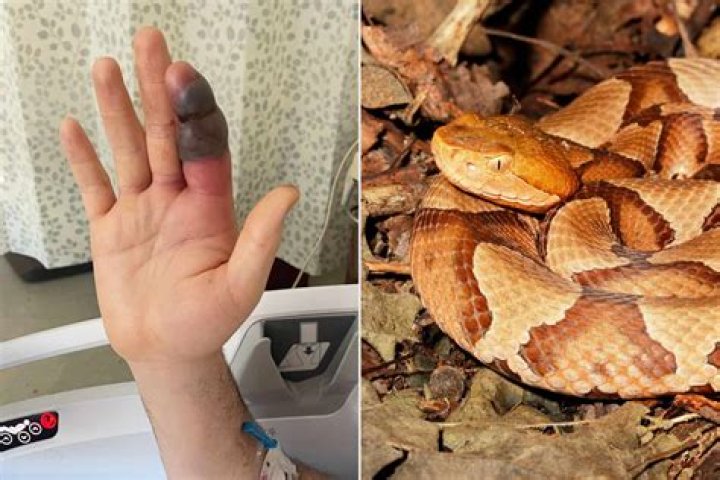 Has anyone ever died from a copperhead bite?