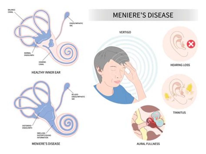What can trigger meniere's disease?